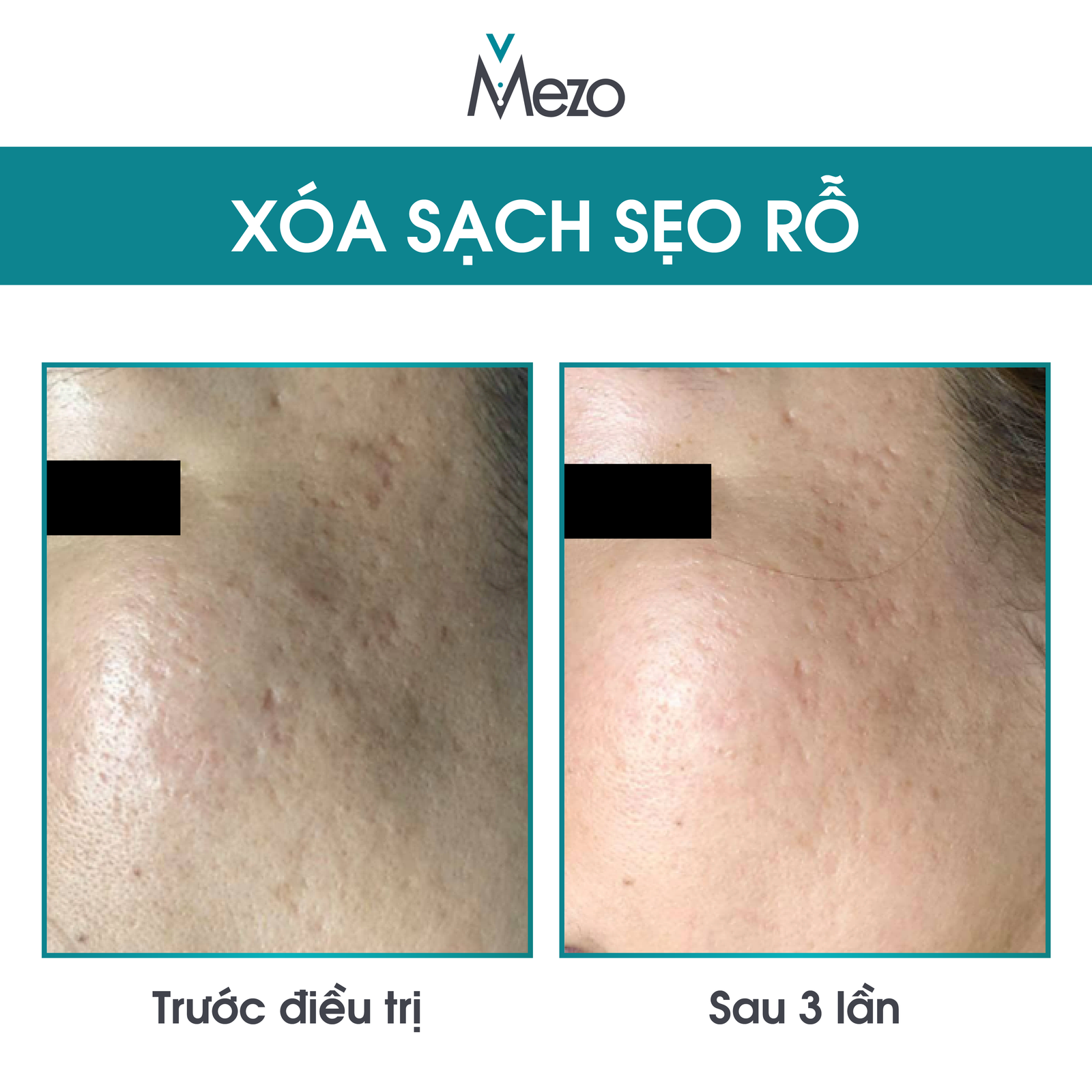 hiệu quả điều trị rỗ