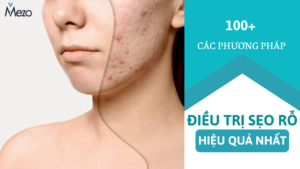 100+ các phương pháp điều trị sẹo rỗ hiệu quả nhất